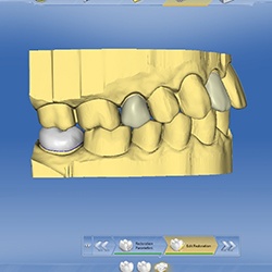 CEREC dental restoration plan