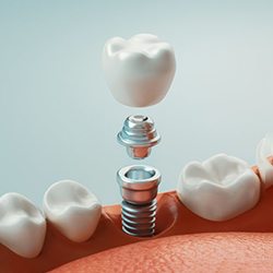 a 3 D illustration of a dental implant and abutment