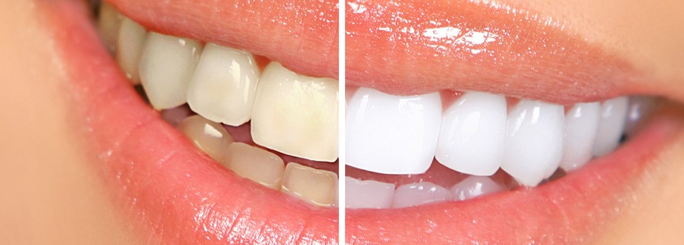 Closeup of smile before and after teeth whitening in Groveport