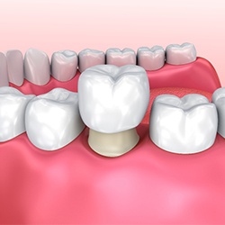 3D Illustration of dental crown
