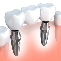 Animation of implant supported fixed bridge placement