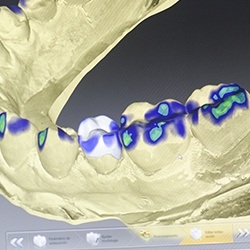 Digital dental impressions on computer screen