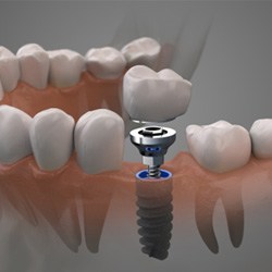 An up-close view of a single dental implant 