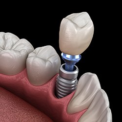 A digital image of a customized dental crown sitting on top of a metal abutment and dental implant