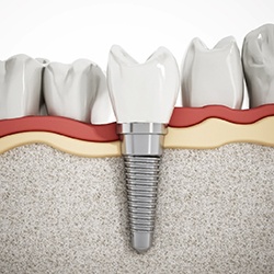 Illustration of a fully integrated dental implant in Groveport, OH