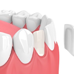 Digital image of a veneer being place on a front tooth