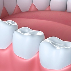 Animation of teeth with dental sealants