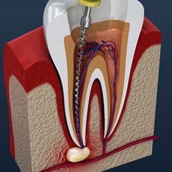 A diagram of what happens in a root canal