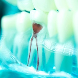 Model of tooth for root canal therapy in Groveport, OH