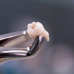 Forceps holding a single tooth after an extraction