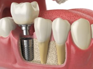 CGI model of a dental implant and its components